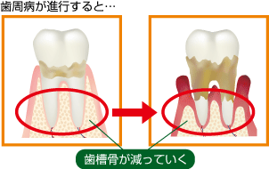 歯周病が進行すると・・・