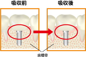インプラントによる骨吸収