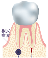 根尖病変イメージ