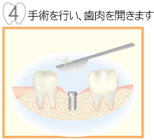 手術を行い歯肉を開きます