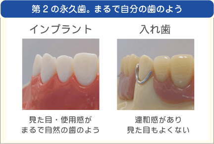 第2の永久歯 まるで自分の歯のよう