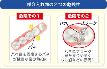 部分入れ歯の2つの危険性